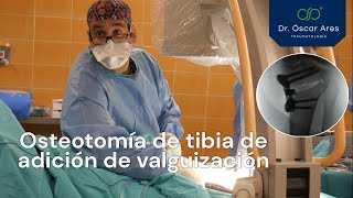 Osteotomía de tibia de adición de valguización  Dr Oscar Ares [upl. by Story40]