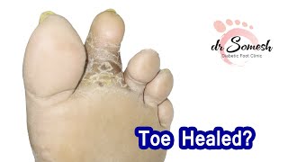 toeinfection saved diabeticfoot diabeticinfection [upl. by Adnorrahs945]