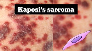 Kaposis sarcoma pathology  Kaposis sarcoma lecture  Quick revision  tarangacademy7561 [upl. by Yetah456]