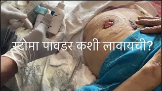 How to use Ostomy powder  Stoma care guide  Stoma powder kaise lagaye  ostomytips shorts [upl. by Airogerg]