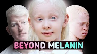 The Lack of Melanin Changes Everything [upl. by Folly]