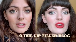 lip filler vlog  07ml lip filler before and after [upl. by Ahseym27]