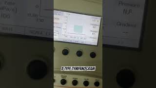 Tympanometry B type tympanogram audiology tympanicmembraneperforation [upl. by Ayrotal]