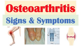 Osteoarthritis Signs amp Symptoms amp Why They Occur [upl. by Ivette]