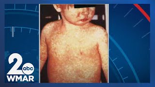 With national international measles upticks Hopkins Dr explains what to know [upl. by Kerril]