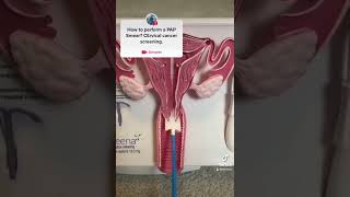 PAP Smear demonstration for Cervical cancer screening MEDICAL TIPS [upl. by Ruford705]