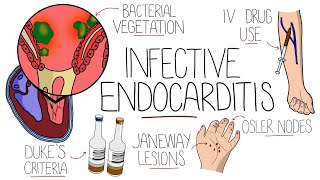 Infective Endocarditis With Duke Criteria amp Pathophysiology [upl. by Ethban]