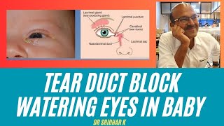 Tear duct block in babies l Nasolacrimal duct obstruction and watering eyes [upl. by Dawson]