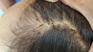 Remove many lice from brown hair  Plucking most of lice from head [upl. by Ennaimaj753]