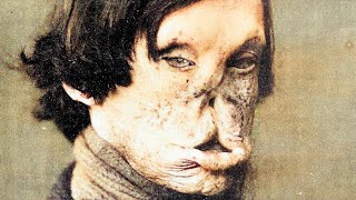 The Most HORRIFIC Diseases In History  A Compilation [upl. by Adnovad]