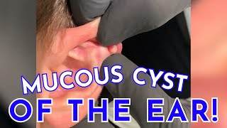 MUCOUS CYST OF THE EAR [upl. by Howe956]