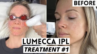 LUMECCA IPL  BEFORE amp AFTER  VLOG [upl. by Gregg541]