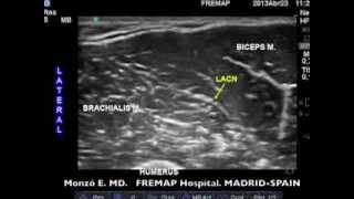 Echoanesthesia Today Lateral Antebrachial Cutaneous Nerve [upl. by Notnroht]