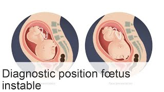 Signification et risques de la position instable du fœtus pour la maman et le bébé [upl. by Erdah947]