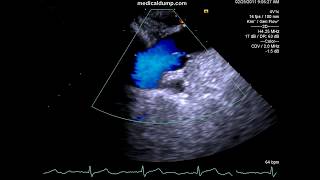 Aortic Dissection  TransEsophageal Echocardiography TEE [upl. by Eduam]