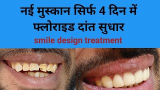 SMILE CORRECTION सामने के दांतों का 4 दिन में इलाज fluorosis teeth correction smile makeover [upl. by Jacobsohn76]