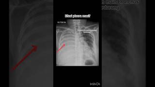 Efusi pleura masif xray radiology röntgen efusipleura [upl. by Abocaj]