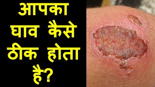 Wound Healing How does it happen  Hindi  Priyank Singhvi [upl. by Ainoet]