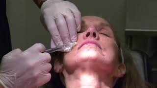 Injection of Botulinum Toxin for Treatment of Perioral Rhytids by Dr Z Paul Lorenc [upl. by Cohn818]