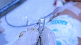 NICU में बेबी को enema कैसे लगाए enema videos nicu viral newborn Nursingwithchandan [upl. by Reivad]