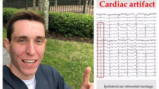 6 EEG Artifacts You Must Know in 6 Minutes [upl. by Eel]