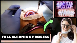 HOW TEETH ARE CLEANED AT THE DENTIST  StepbyStep Guided Biofilm Therapy [upl. by Eillib]