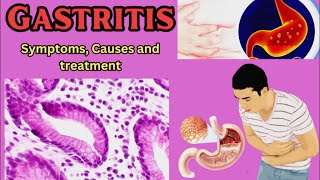 Gastritis Symptoms Causes and Treatment [upl. by Vernice51]