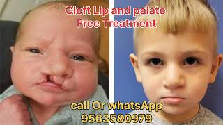 CLEFT LIP AND PALATE TREATMENT FREE IN SILIGURI II CLEFT LIP FREE TREATMENT cleftsurgery [upl. by Nyliahs873]