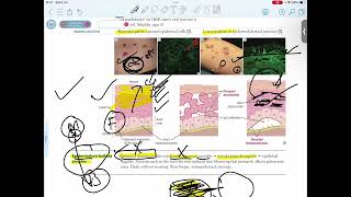 EPIDERMOLYSIS BULLOSA SIMPLEX [upl. by Kerin]