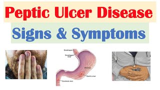 Peptic Ulcer Disease Signs amp Symptoms  Gastric vs Duodenal Ulcers [upl. by Halimaj]