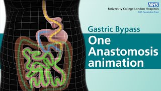 Gastric Bypass  One Anastomosis animation [upl. by Myriam26]