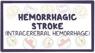 Hemorrhagic stroke intracerebral hemorrhage  causes symptoms diagnosis treatment pathology [upl. by Initirb]