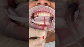 Porcelain veneers procedure  porcelain veneers before and after  smile makeover  Dr Yazdan [upl. by Monroe]