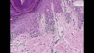 Histopathology SkinMelanoma in situ [upl. by Schroth]