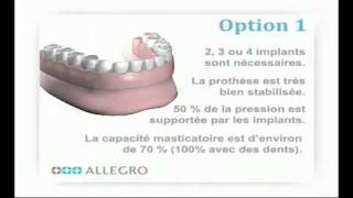 Implants dentaires  Prothèse sur piliers boules [upl. by Navets505]