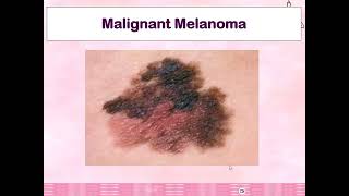 Malignant Melanoma1 [upl. by Combs]