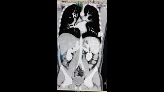 الاشعه المقطعيه علي الشريان الاورطي بالصبغه CT angiography of aorta part 1 [upl. by Ledoux]