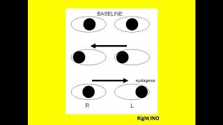 Internuclear Ophthalmoplehia  Conjugate Gaze Palsy [upl. by Pergrim]