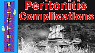 Diverticulitis to Peritonitis  Peritonitis and Sepsis Complications [upl. by Travax]