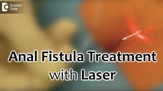 Anal Fistula Treatment with Laser Painless and best recovery for fistula  Dr Rajasekhar M R [upl. by Araid]