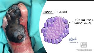 Necrosis and its types coagulative liquefactive caseous fat fibrinoid necrosis fmge neetpg [upl. by Anirac]