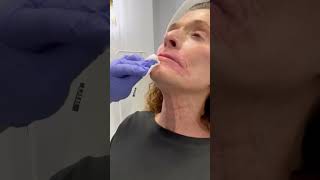 Botox for platysmal bands in the neck [upl. by Gardell]