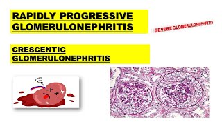 RPGN  Rapidly Progressive Glomerulonephritis  Poor Prognosis  Made Easy [upl. by Emerej607]