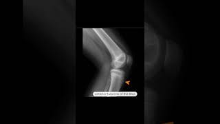 OsgoodSchlatter disease [upl. by Pogue964]