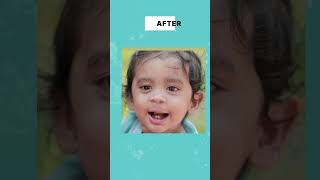 Miracle Transformation after Cleft Lip Surgery in India  Dr Mathew PC shorts [upl. by Gentilis]