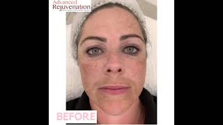 Cosmelan Treatment Results  Skin DePigmentation and Anti Ageing  By Advanced Rejuvenation [upl. by Flss]