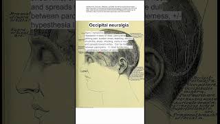 Occipital neuralgia [upl. by Hgielah]