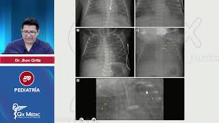 Displasia broncopulmonar  Pediatría 2024 [upl. by Ahsieyn]