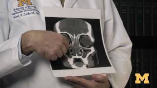 How do I know if I need sinus surgery [upl. by Helaine]