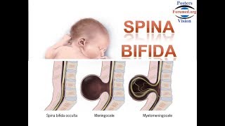 Spina Bifida les Causes et la Prévention par acide folique vitamine B9 [upl. by Pillyhp]